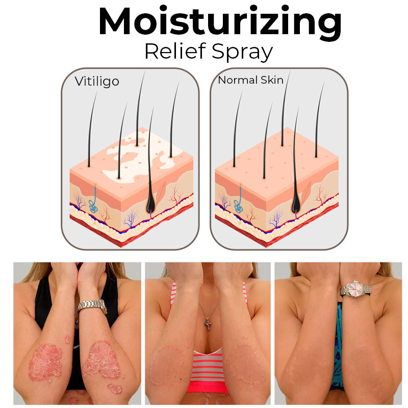 South moon™ - Vitiligo Relief Spray für die Haut